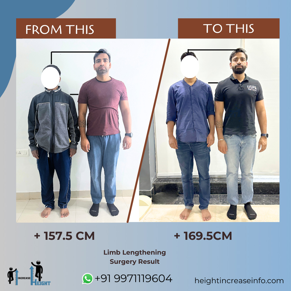 Limb Lengthening Result 1